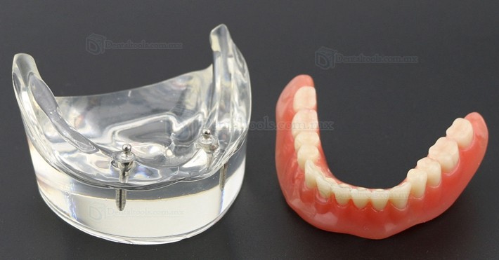 Dental Inferiores Modelo de Implante de sobredentadura 2 Implantes Demostración Modelo 6002 01